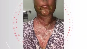 Farmacêutico e clínica que causaram queimaduras em mulher após peeling são condenados a pagar R$ 125 mil de indenização