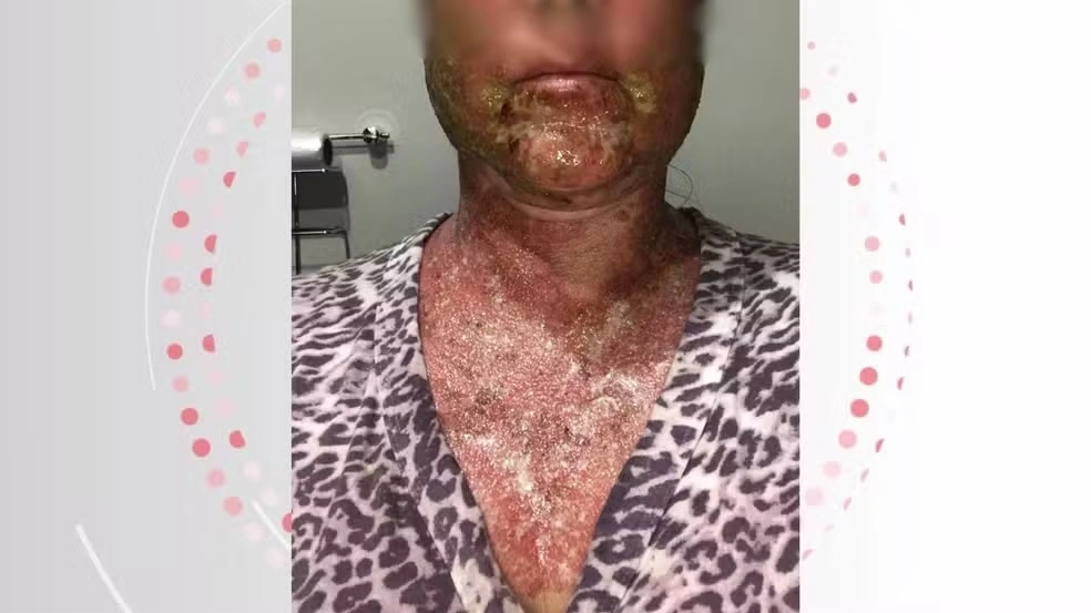 Farmacêutico e clínica que causaram queimaduras em mulher após peeling são condenados a pagar R$ 125 mil de indenização