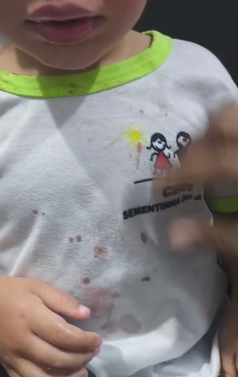 Criança de 2 anos chega à creche com graves ferimentos e padrasto é preso em Palotina