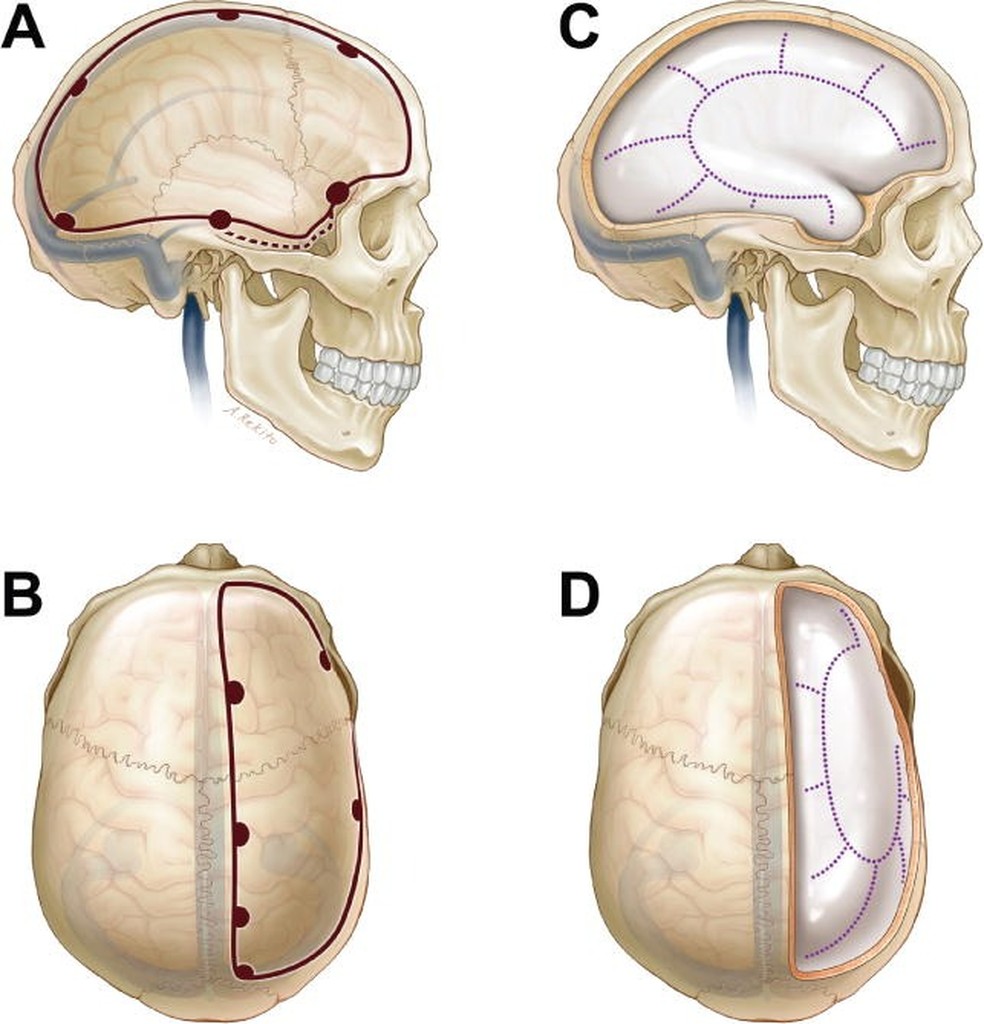 Ilustração mostra como parte da calota craniana é cortada durante o procedimento — Foto: Reprodução/artigo científico “Wartime decompressive craniectomy: technique and lessons learned”